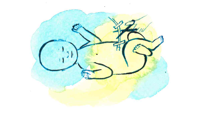 Illustration av en nyfödd bebis som får navelsträngen klippt.
